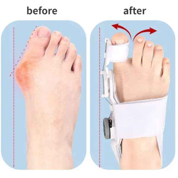 1PC Bunion Corrector Unisex Foot Hallux Valgus Braces Rotatable Toe Separator Straightener Adjustable Finger Toe Corrector - Image 3