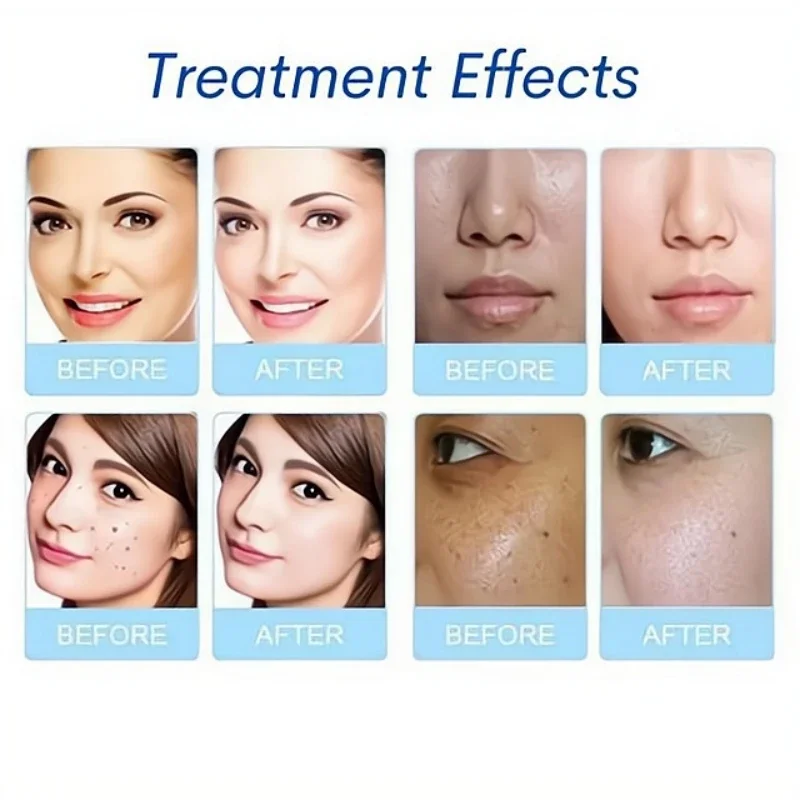 3Pcs/Set Serum Aqua Peel Solution Concentrated Solution Deep Clean Essence For Facial Skincare Hydro Dermabrasion Beauty Machine - Image 6